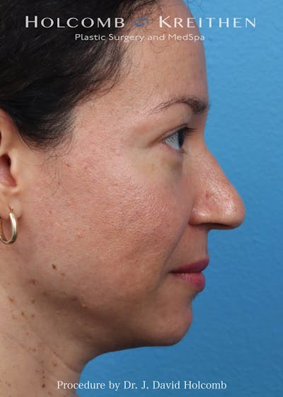 Rhinoplasty Before & After Gallery - Patient 169080 - Image 1