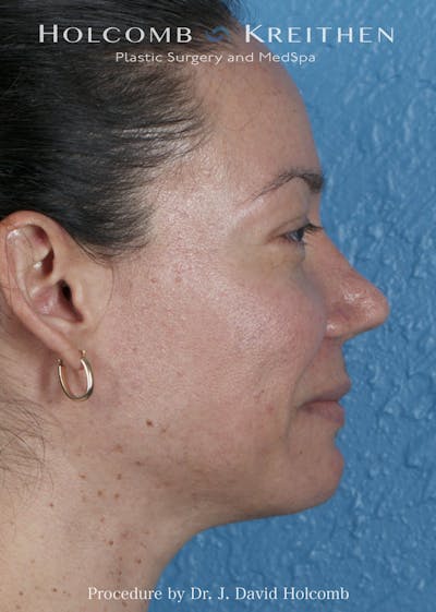 Rhinoplasty Before & After Gallery - Patient 169080 - Image 2