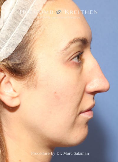 Rhinoplasty Before & After Gallery - Patient 427813 - Image 1