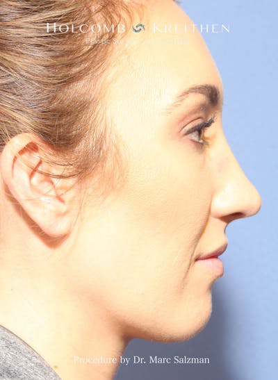 Rhinoplasty Before & After Gallery - Patient 427813 - Image 2