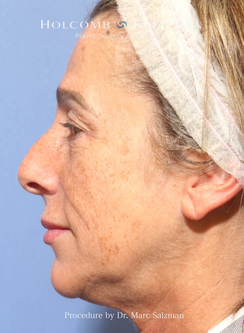Rhinoplasty Before & After Gallery - Patient 423396 - Image 1