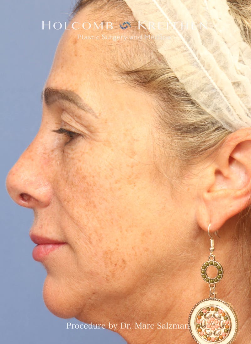 Rhinoplasty Before & After Gallery - Patient 423396 - Image 2