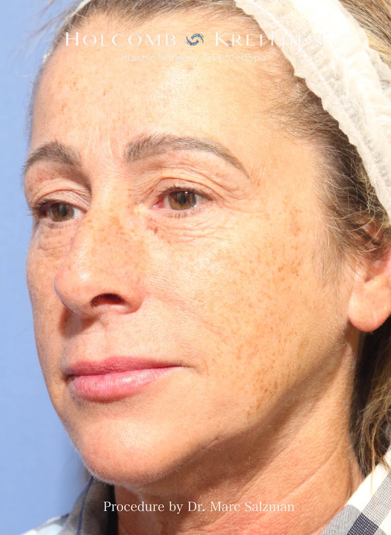 Rhinoplasty Before & After Gallery - Patient 423396 - Image 3
