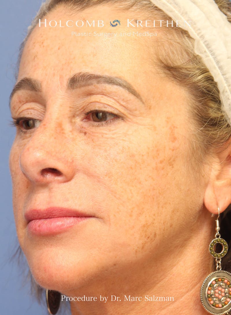Rhinoplasty Before & After Gallery - Patient 423396 - Image 4