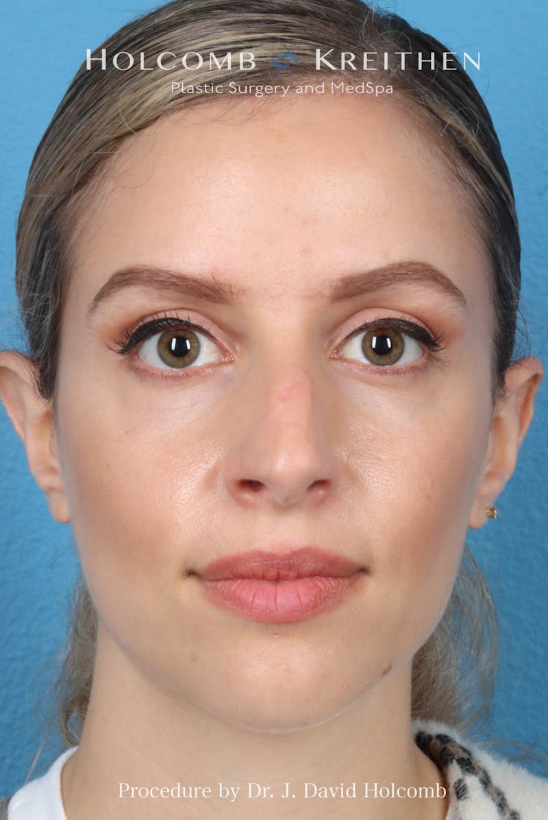 Rhinoplasty Before & After Gallery - Patient 268066 - Image 3