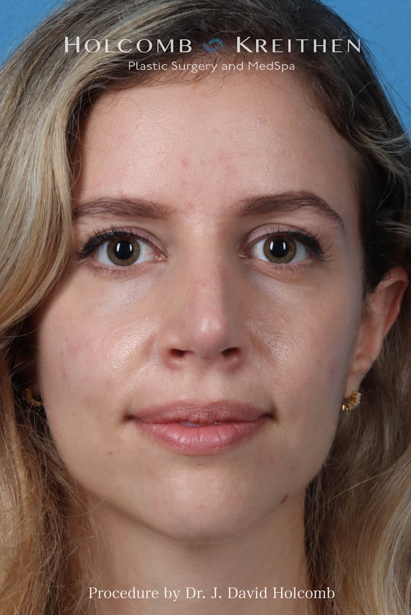 Rhinoplasty Before & After Gallery - Patient 268066 - Image 4