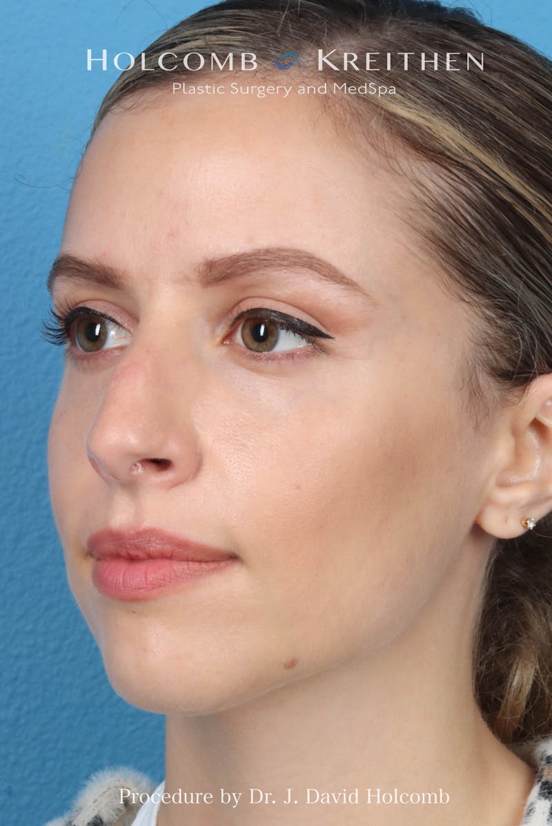 Rhinoplasty Before & After Gallery - Patient 268066 - Image 5
