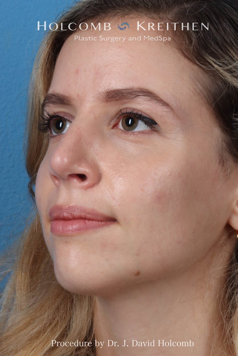 Rhinoplasty Before & After Gallery - Patient 268066 - Image 6