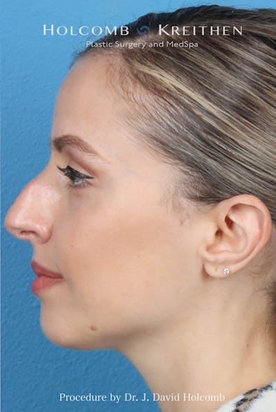 Rhinoplasty Before & After Gallery - Patient 268066 - Image 1