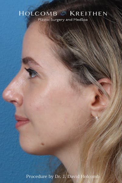 Rhinoplasty Before & After Gallery - Patient 268066 - Image 2