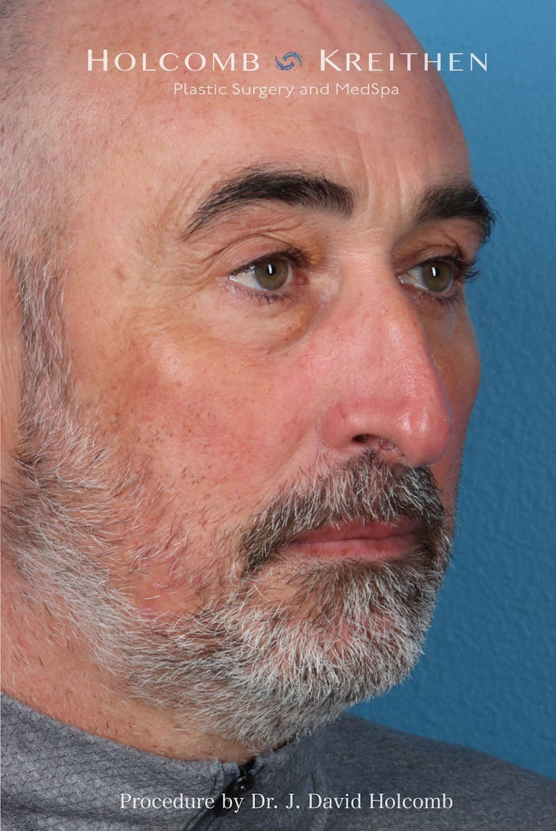 Rhinoplasty Before & After Gallery - Patient 187889 - Image 5