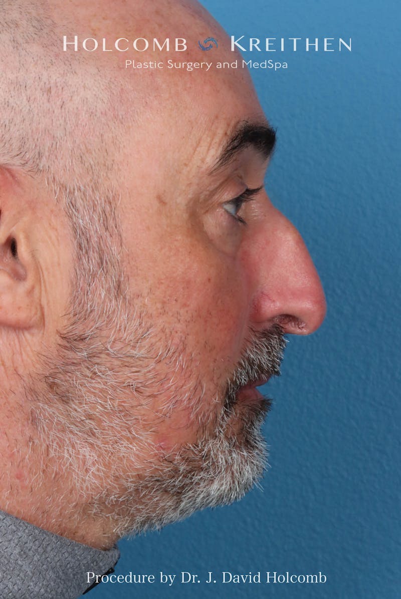 Rhinoplasty Before & After Gallery - Patient 187889 - Image 7