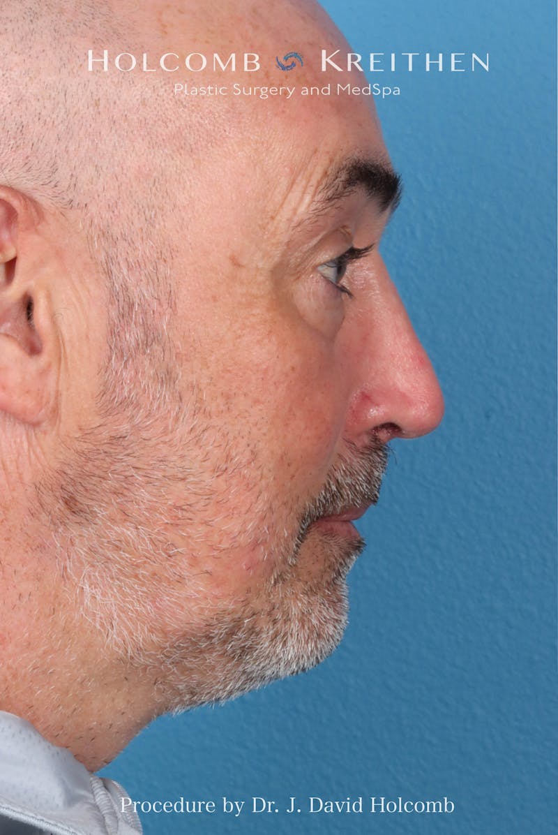 Rhinoplasty Before & After Gallery - Patient 187889 - Image 8