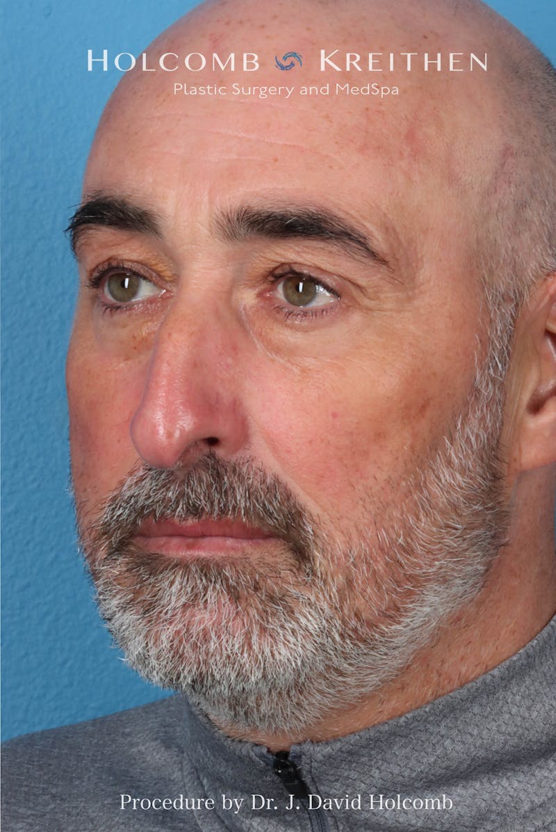 Rhinoplasty Before & After Gallery - Patient 187889 - Image 9