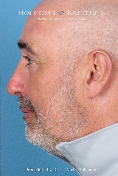 Rhinoplasty Before & After Gallery - Patient 187889 - Image 2