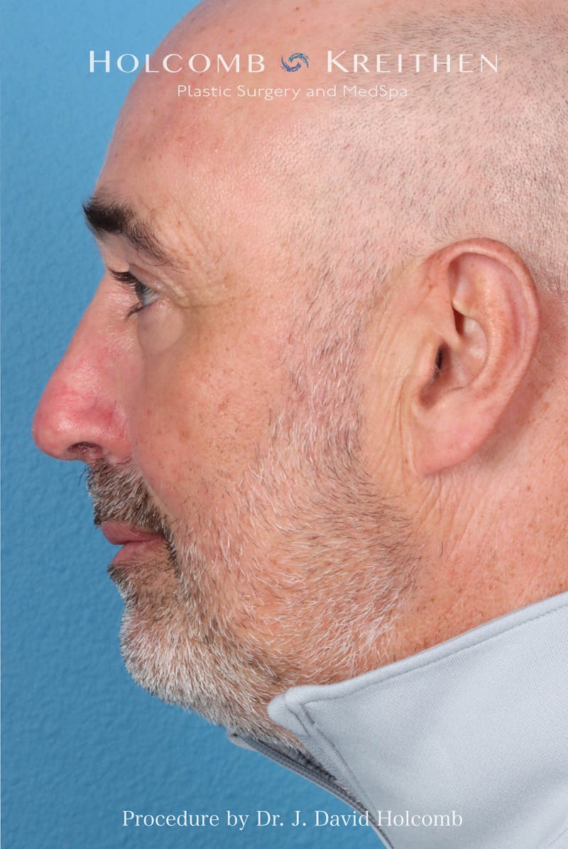 Rhinoplasty Before & After Gallery - Patient 187889 - Image 2