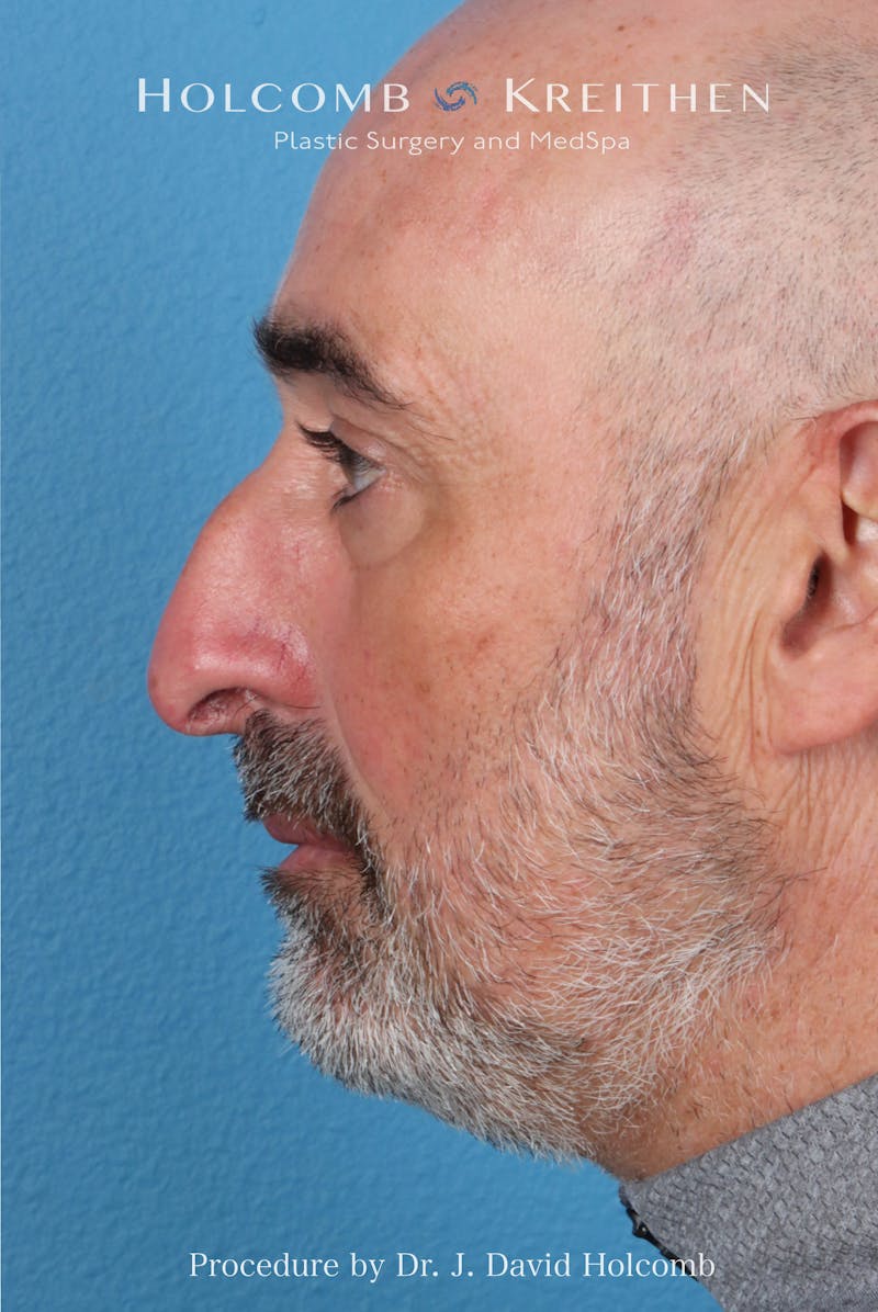 Rhinoplasty Before & After Gallery - Patient 187889 - Image 1