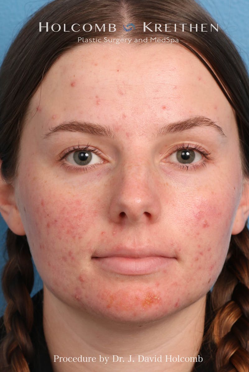 Rhinoplasty Before & After Gallery - Patient 388231 - Image 1