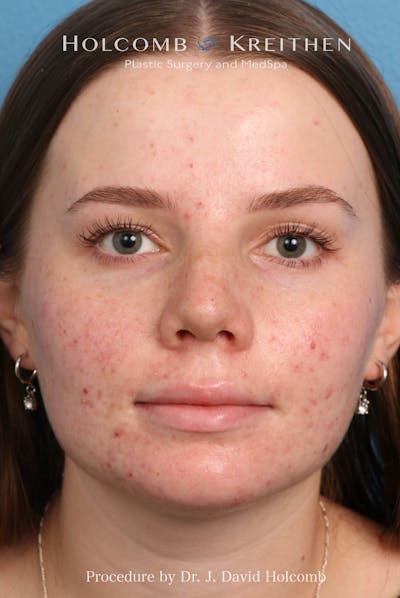 Rhinoplasty Before & After Gallery - Patient 388231 - Image 2