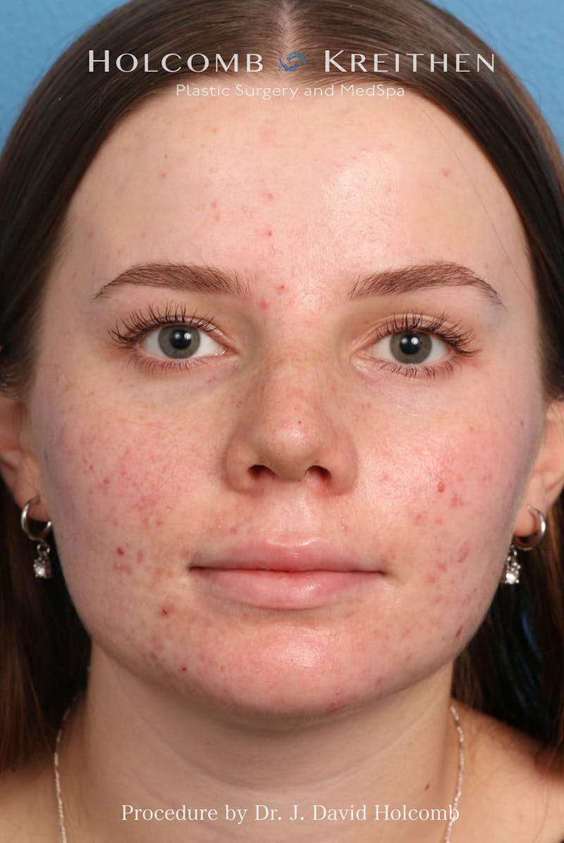 Rhinoplasty Before & After Gallery - Patient 388231 - Image 2