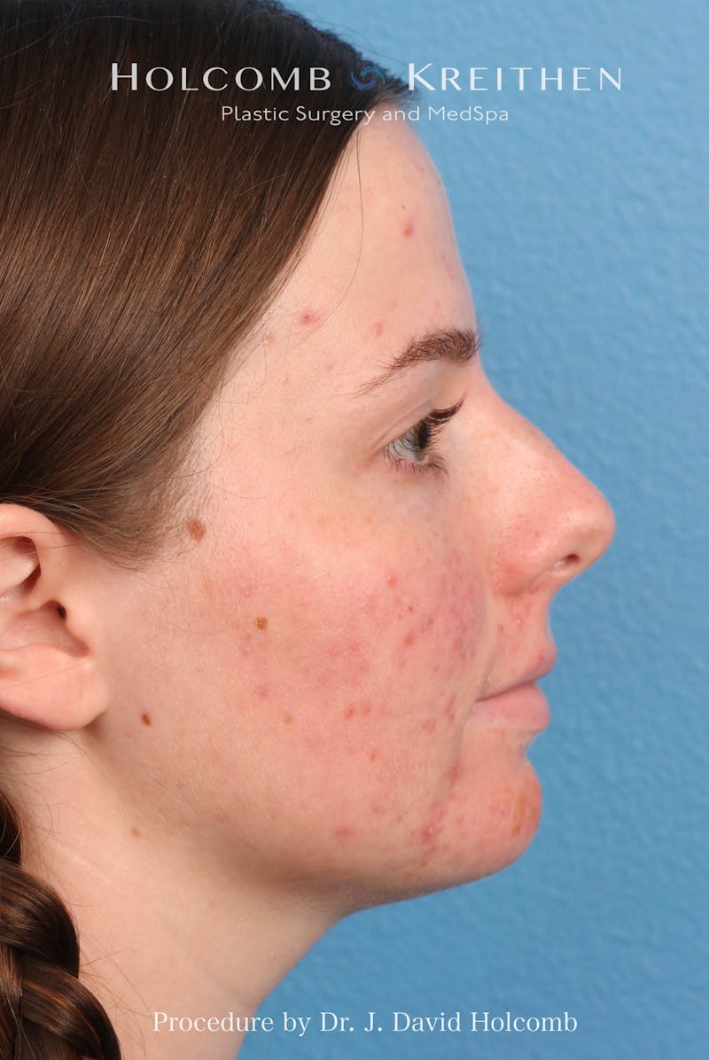 Rhinoplasty Before & After Gallery - Patient 388231 - Image 3