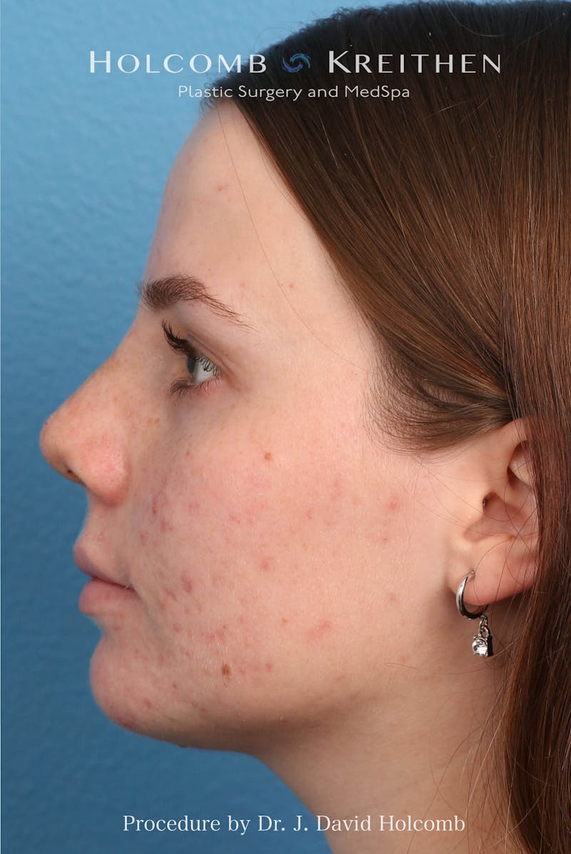 Rhinoplasty Before & After Gallery - Patient 388231 - Image 6