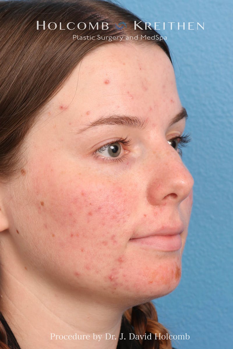 Rhinoplasty Before & After Gallery - Patient 388231 - Image 7