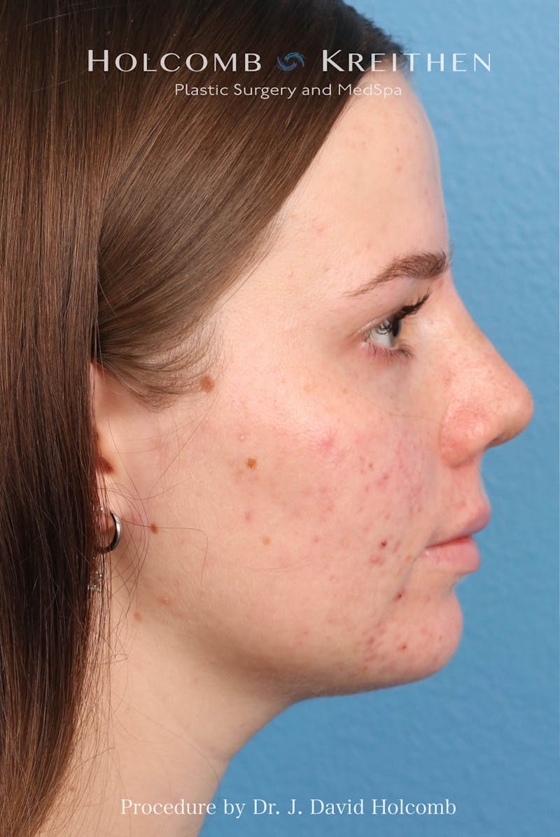 Rhinoplasty Before & After Gallery - Patient 388231 - Image 4