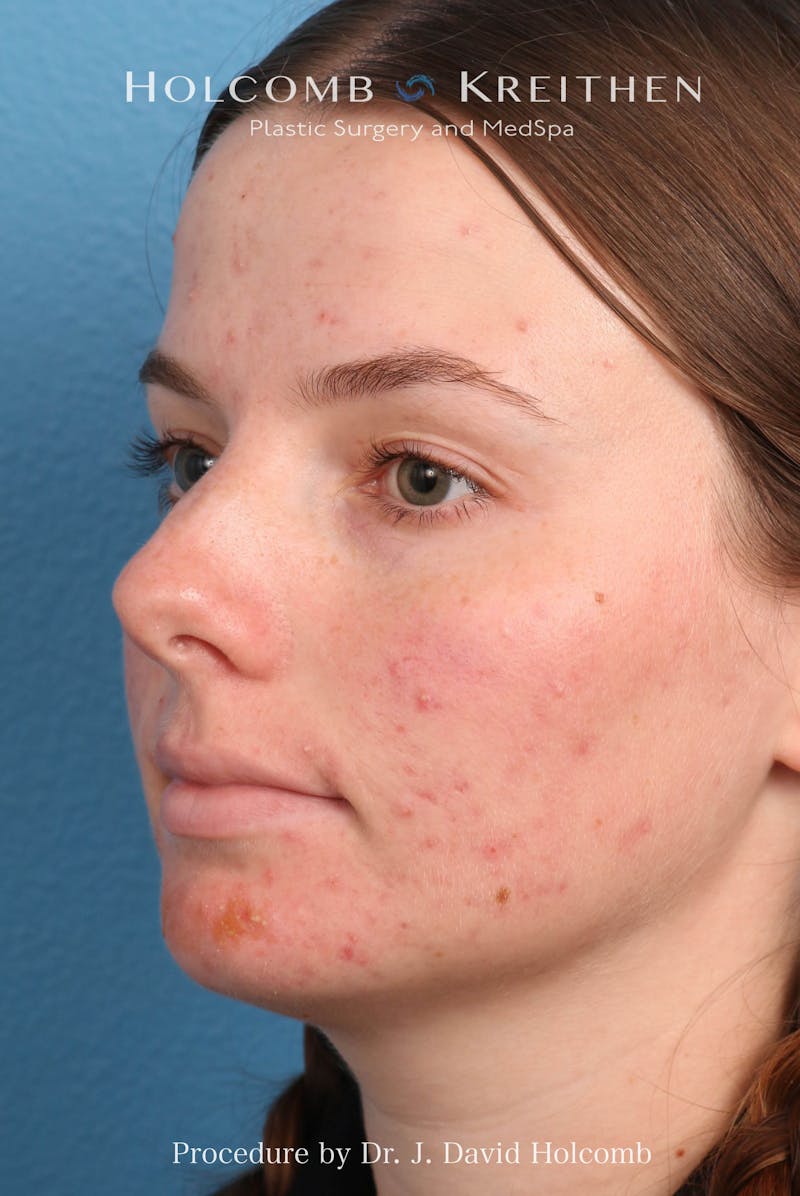 Rhinoplasty Before & After Gallery - Patient 388231 - Image 9