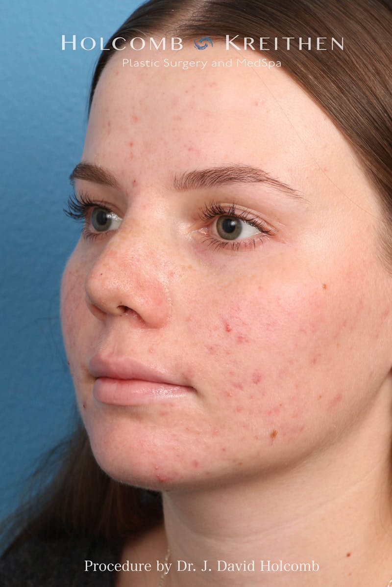 Rhinoplasty Before & After Gallery - Patient 388231 - Image 10