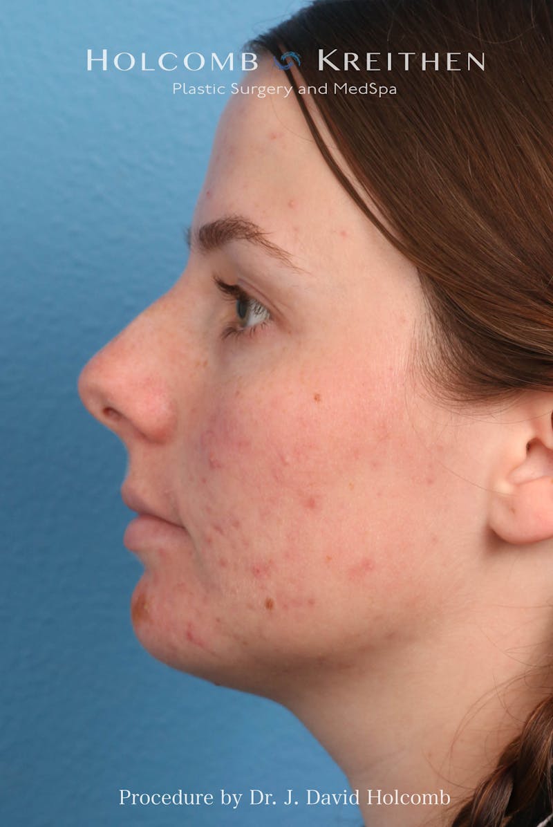 Rhinoplasty Before & After Gallery - Patient 388231 - Image 5