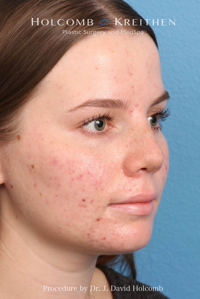 Rhinoplasty Before & After Gallery - Patient 388231 - Image 8