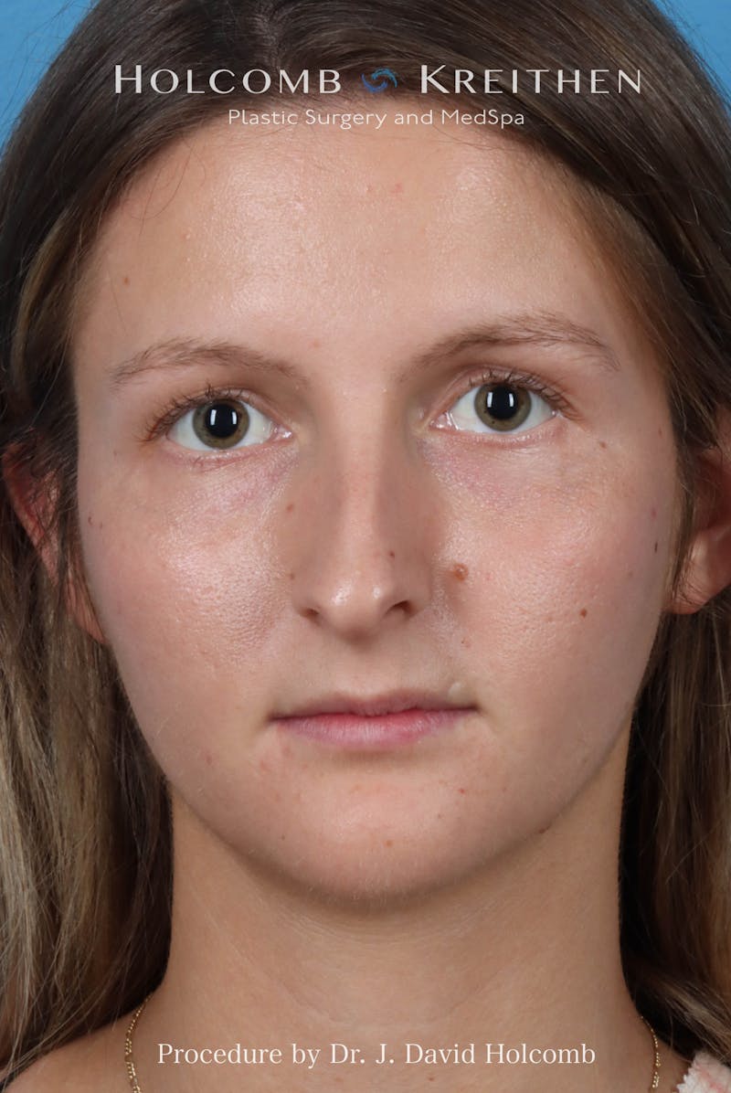 Rhinoplasty Before & After Gallery - Patient 122376 - Image 3