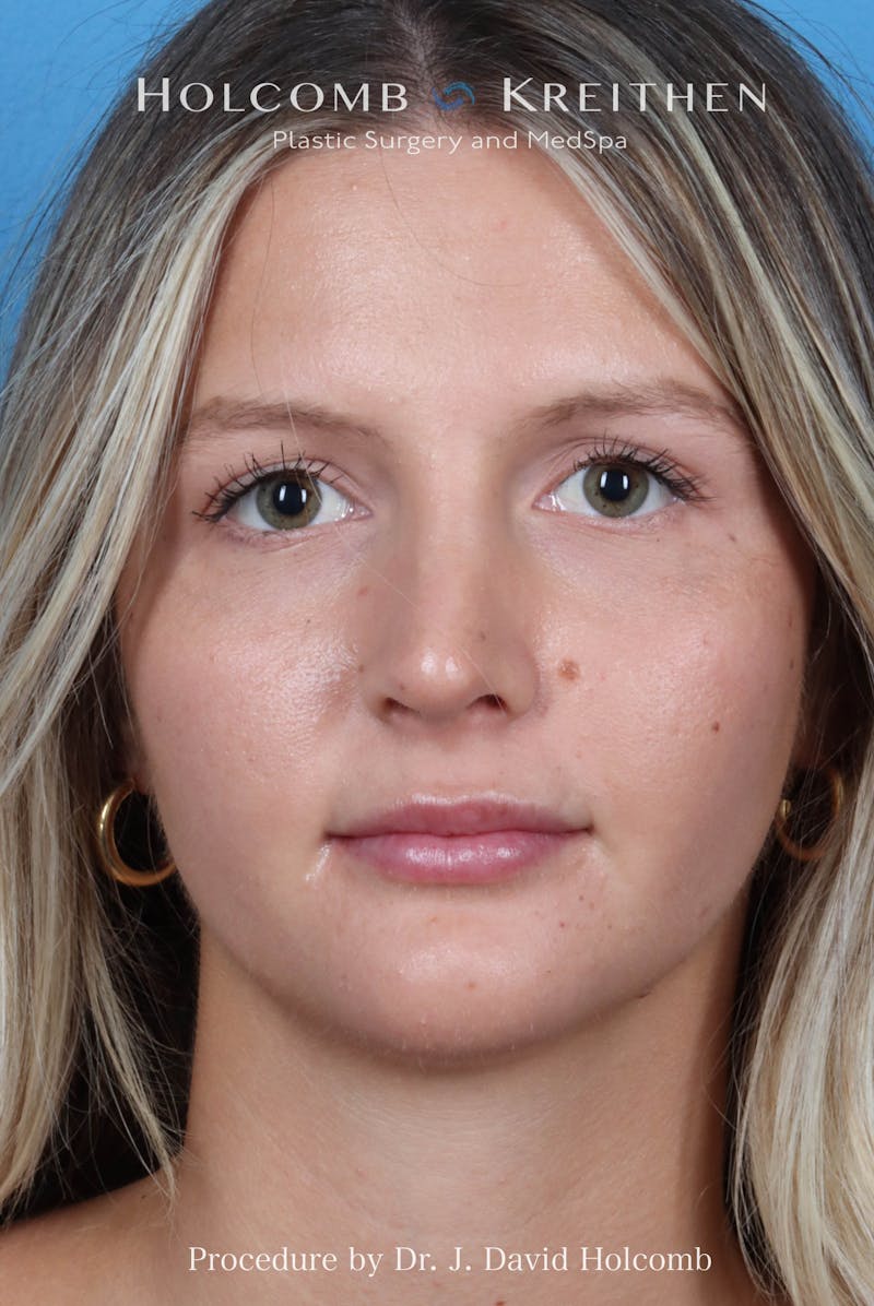 Rhinoplasty Before & After Gallery - Patient 122376 - Image 4