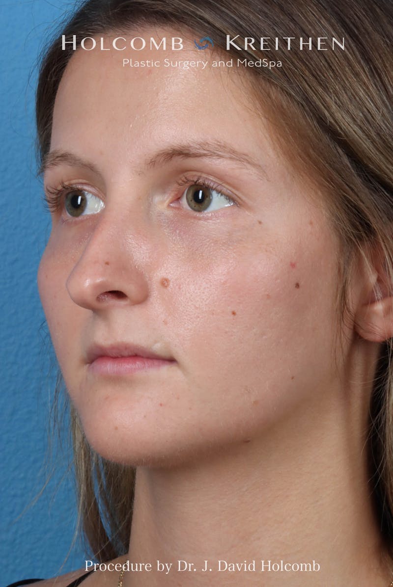 Rhinoplasty Before & After Gallery - Patient 122376 - Image 5