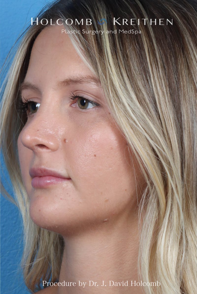 Rhinoplasty Before & After Gallery - Patient 122376 - Image 6