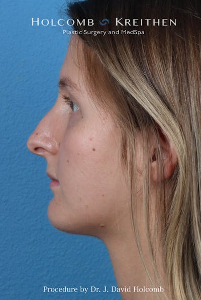 Rhinoplasty Before & After Gallery - Patient 122376 - Image 1