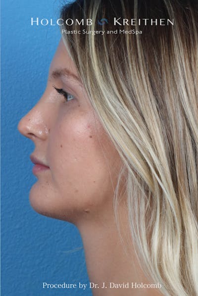 Rhinoplasty Before & After Gallery - Patient 122376 - Image 2