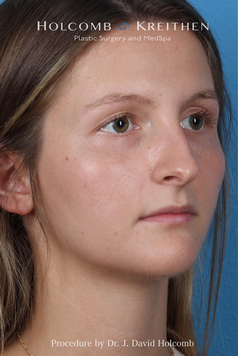 Rhinoplasty Before & After Gallery - Patient 122376 - Image 7