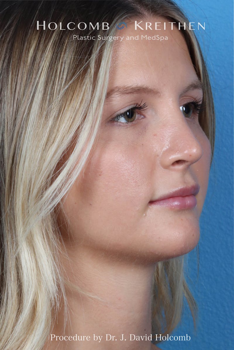 Rhinoplasty Before & After Gallery - Patient 122376 - Image 8