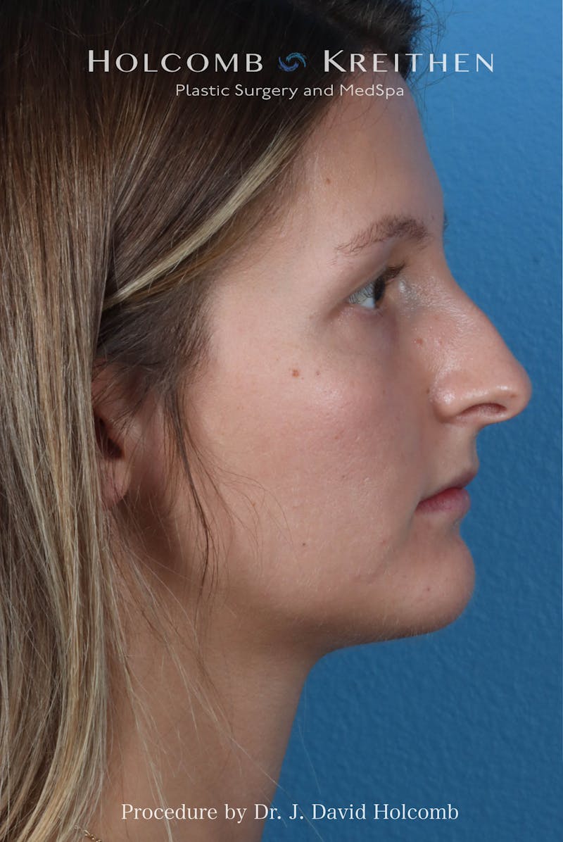 Rhinoplasty Before & After Gallery - Patient 122376 - Image 9