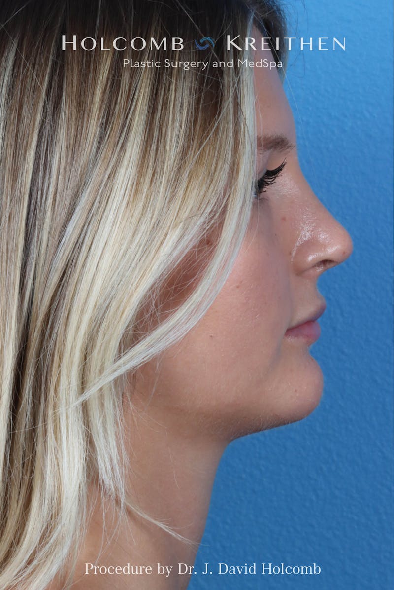 Rhinoplasty Before & After Gallery - Patient 122376 - Image 10