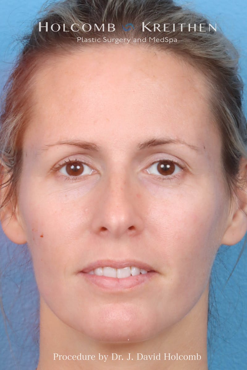 Rhinoplasty Before & After Gallery - Patient 217977 - Image 3