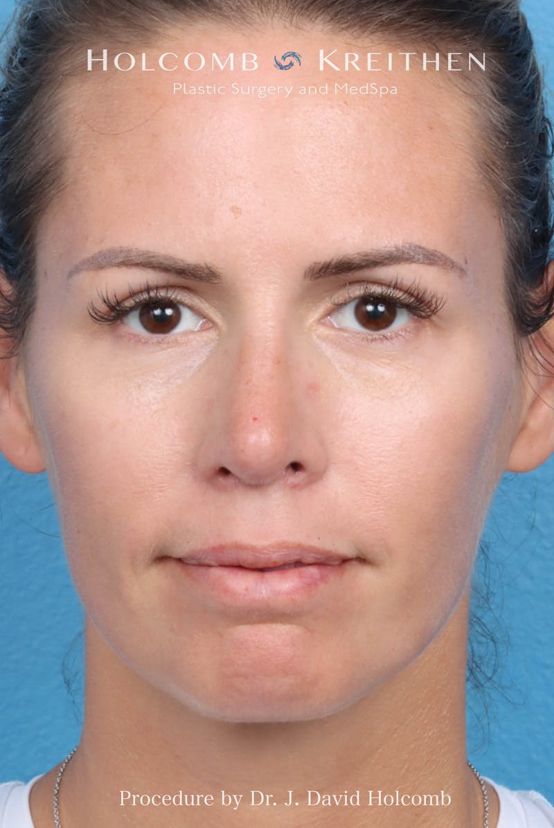 Rhinoplasty Before & After Gallery - Patient 217977 - Image 4