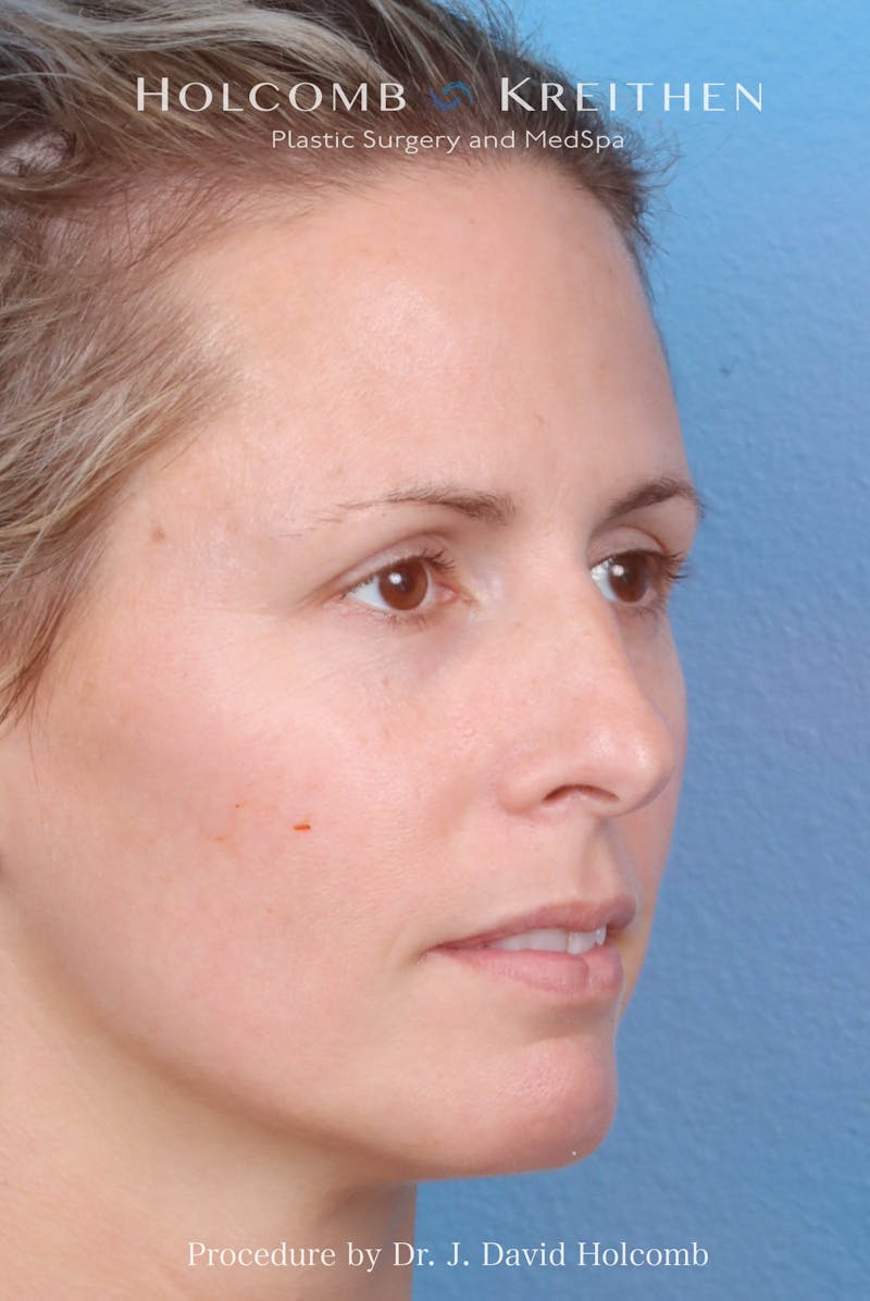 Rhinoplasty Before & After Gallery - Patient 217977 - Image 5