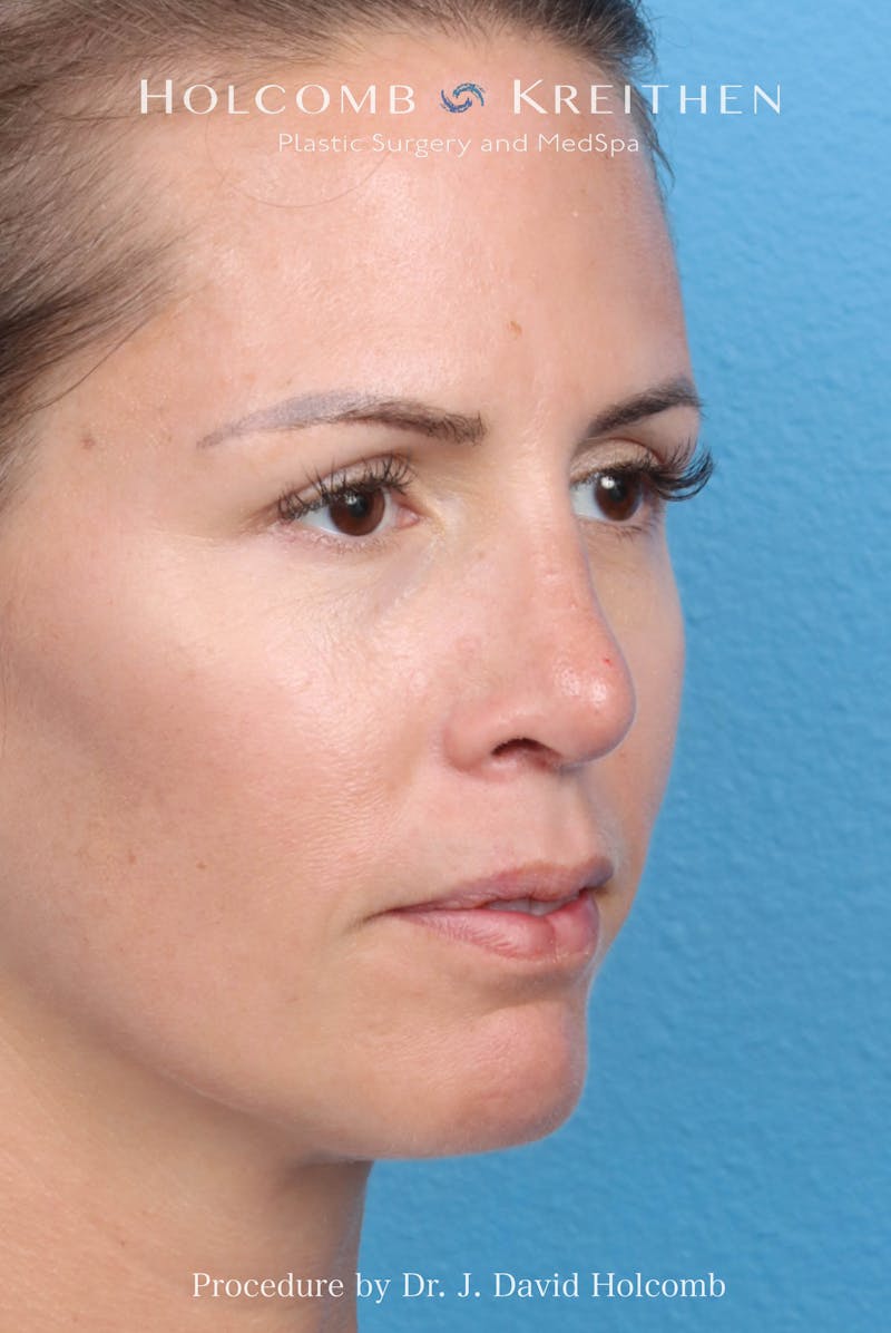 Rhinoplasty Before & After Gallery - Patient 217977 - Image 6