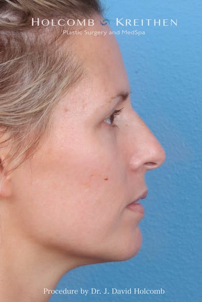 Rhinoplasty Before & After Gallery - Patient 217977 - Image 1