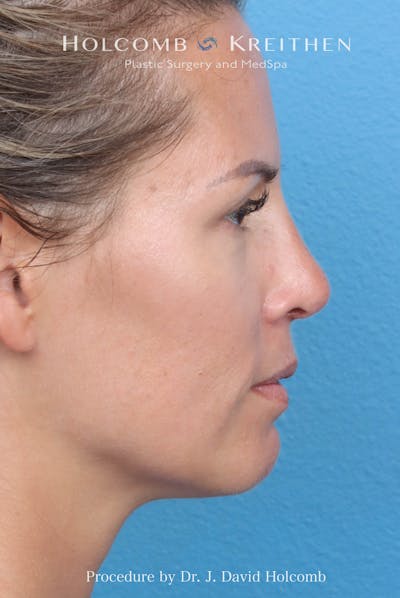 Rhinoplasty Before & After Gallery - Patient 217977 - Image 2