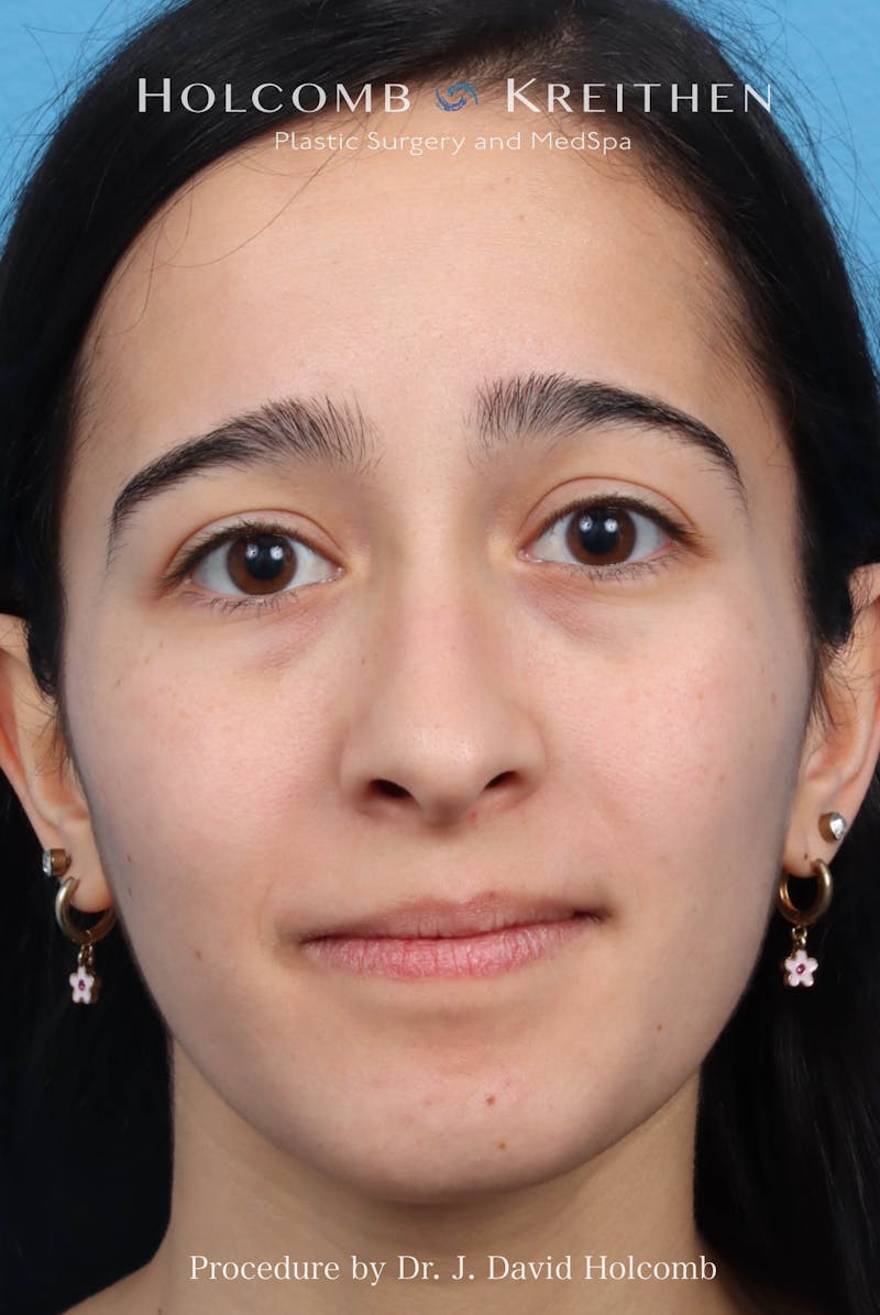 Rhinoplasty Before & After Gallery - Patient 369701 - Image 3