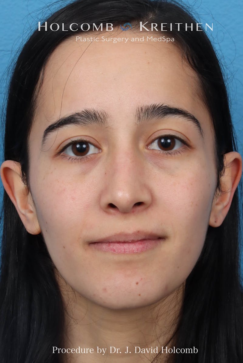 Rhinoplasty Before & After Gallery - Patient 369701 - Image 4